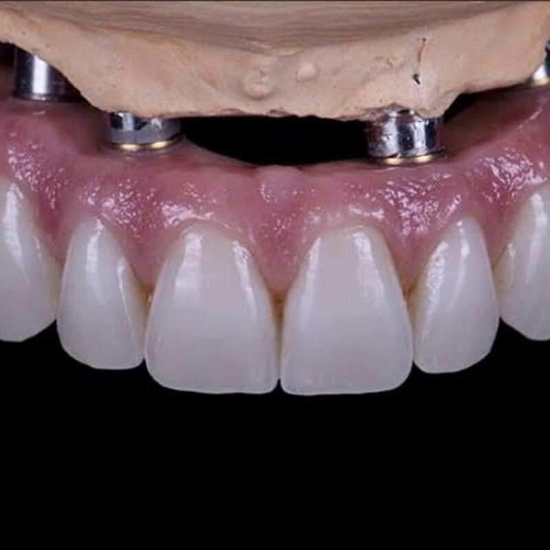 DENTAL IMPLANT