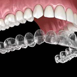 INVISALIGN