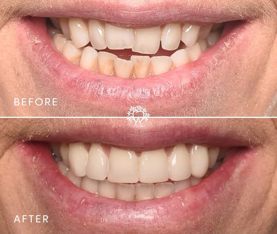 Smile alignment